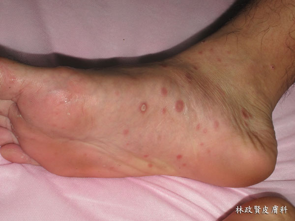二期梅毒 手掌脚底长疹子