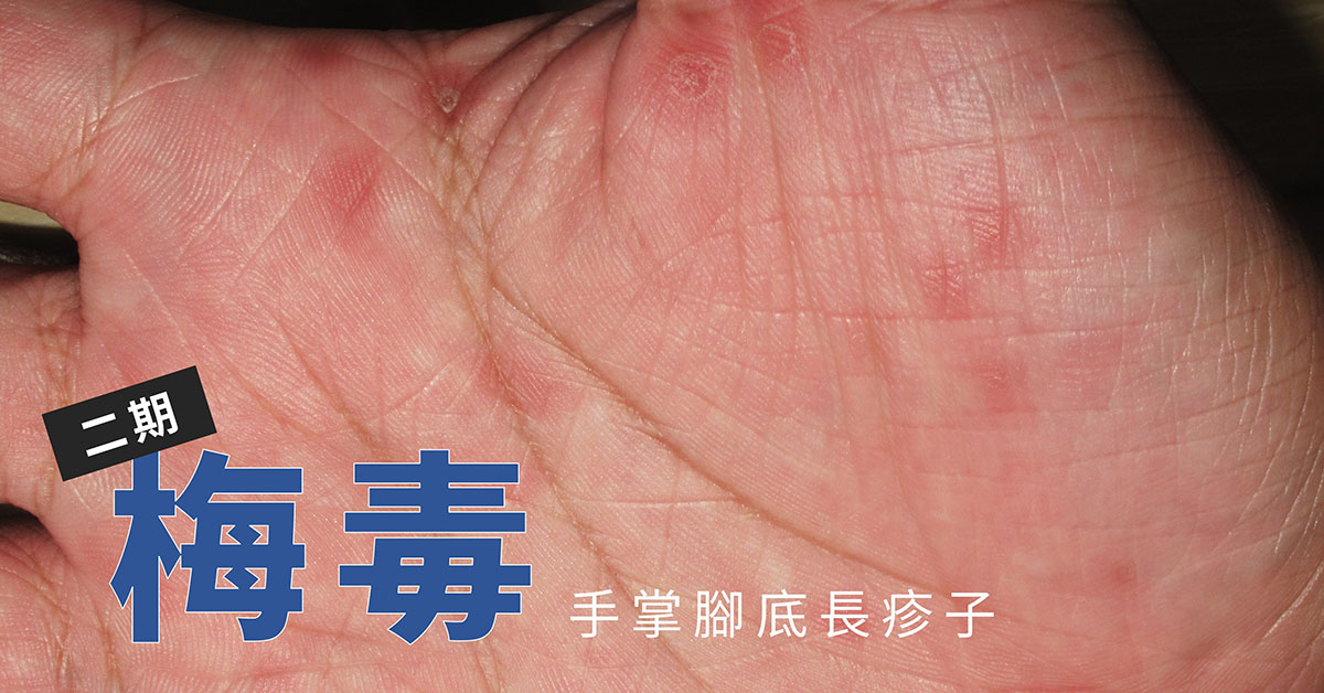 二期梅毒 手掌脚底长疹子 | 高雄林政贤皮肤科诊所