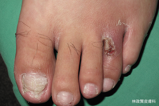灰指甲,灰趾甲,甲癬,蜂窩性組織炎